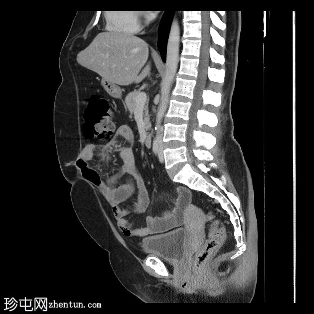 胰腺粘液囊腺瘤