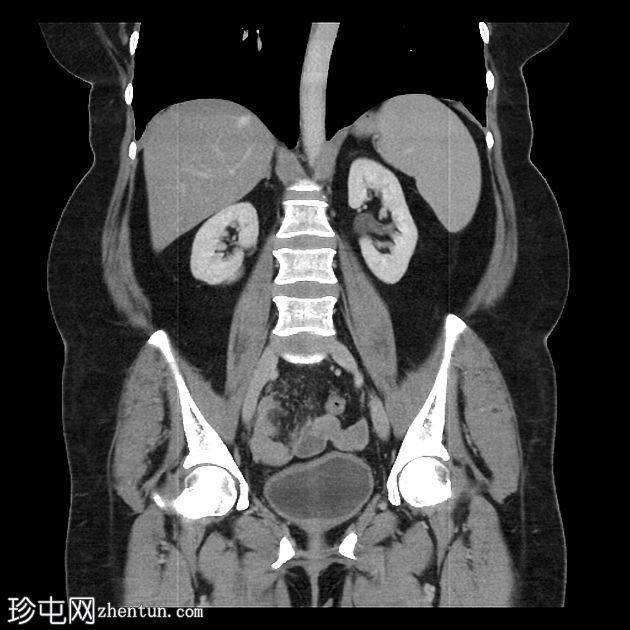 胰腺粘液囊腺瘤