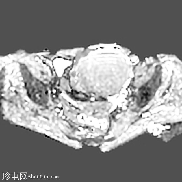 小肠平滑肌瘤