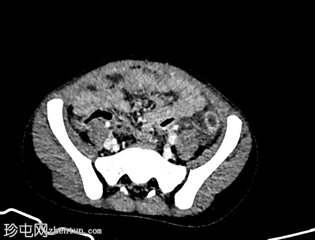 急性阑尾炎伴全反位
