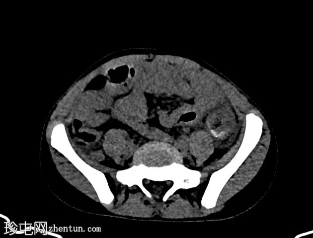 急性阑尾炎伴全反位