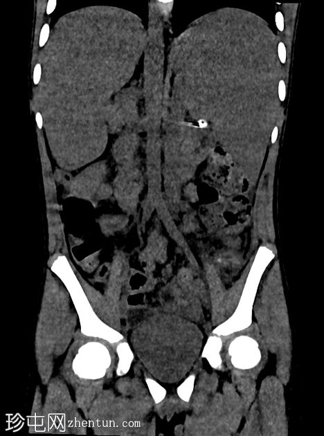 急性阑尾炎伴全反位
