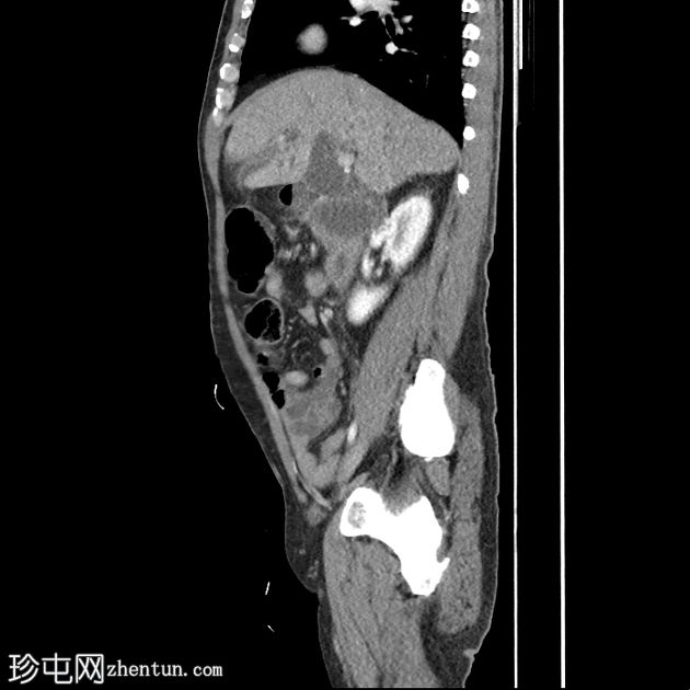 十二指肠腺癌