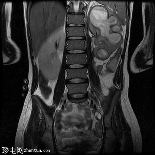 肾脓肿并发肾皮瘘