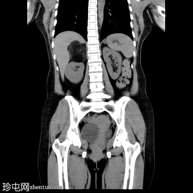 肾上腺髓质脂肪瘤