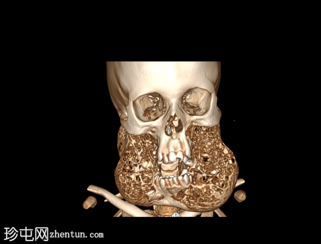 颌骨增大症
