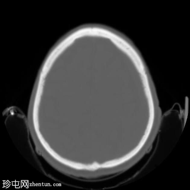 持续性异位缝合