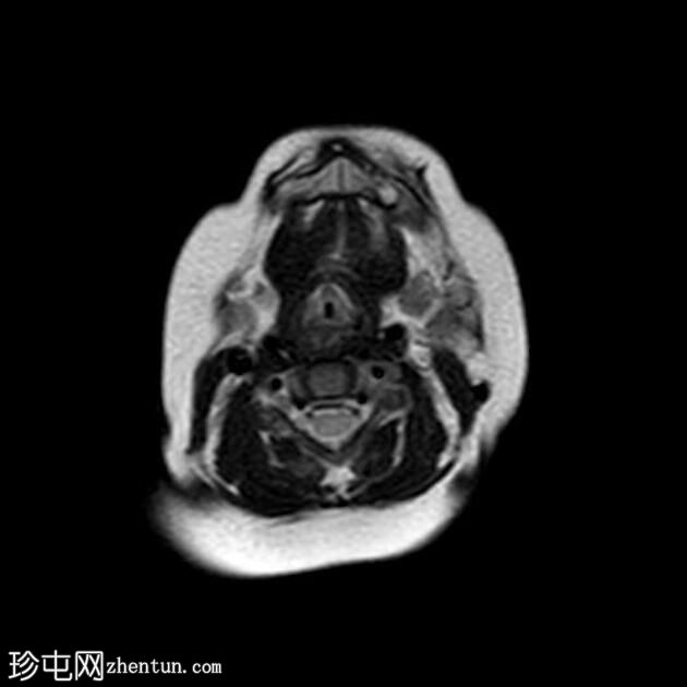 腮腺血管瘤