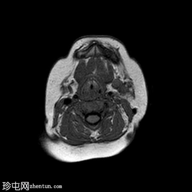 腮腺血管瘤