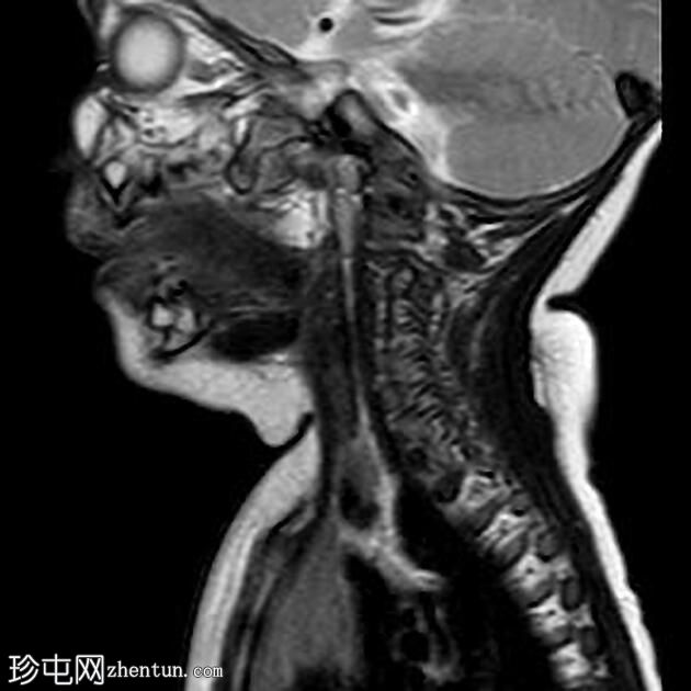 腮腺血管瘤