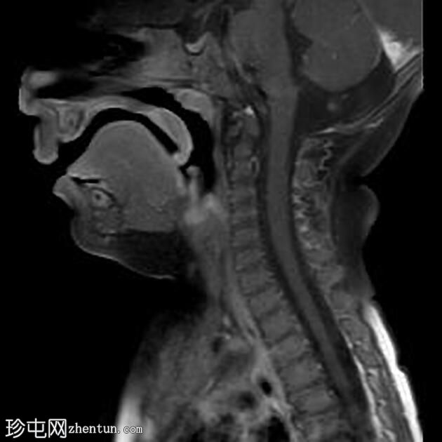 腮腺血管瘤