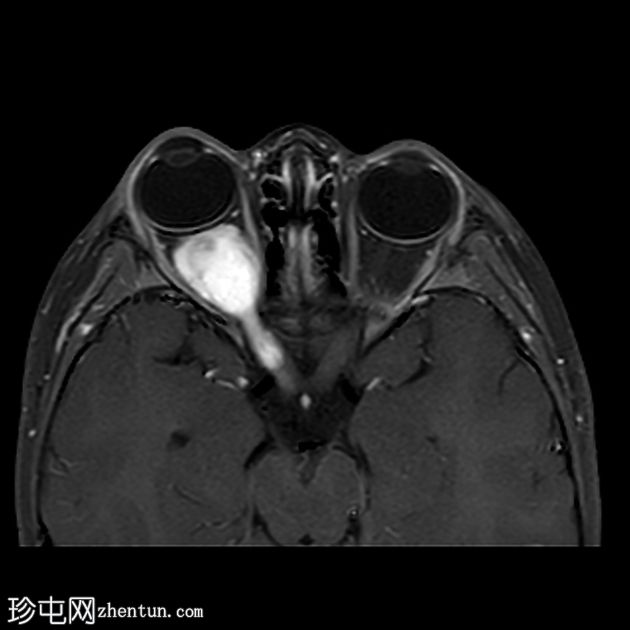 视神经胶质瘤
