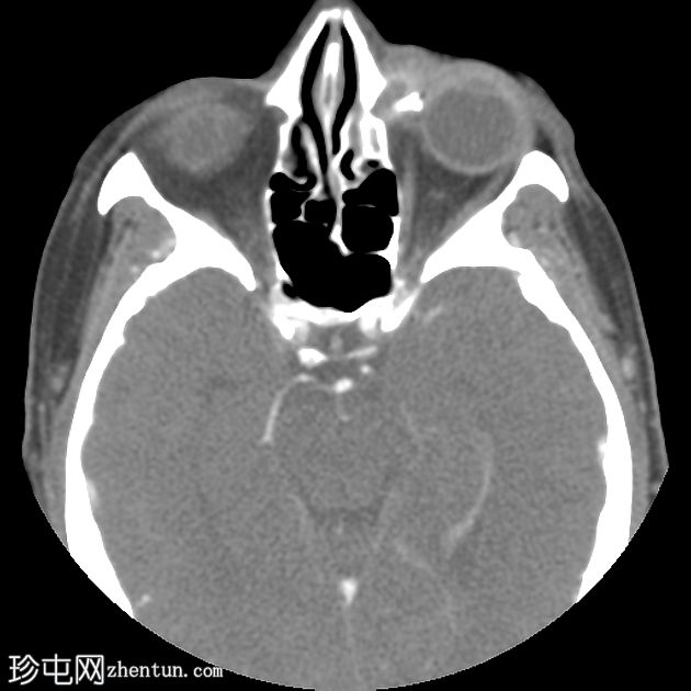 鼻泪管合并感染