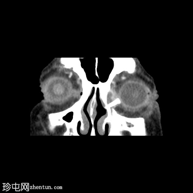 鼻泪管合并感染