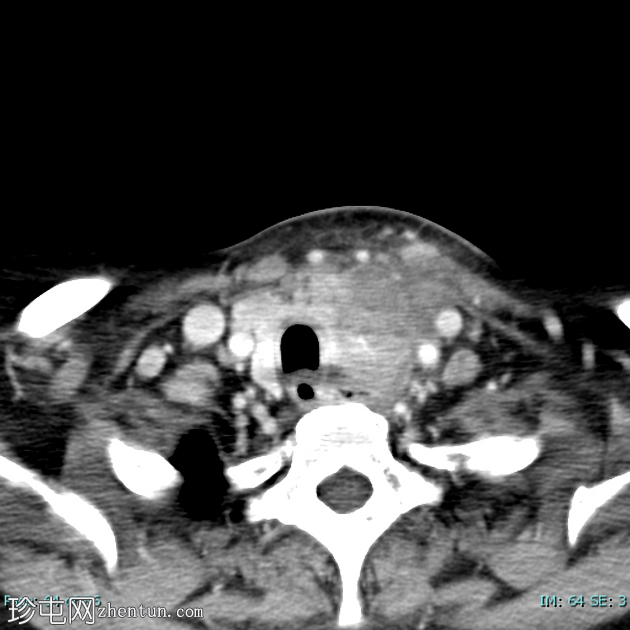 低分化甲状腺癌（FDG PET-CT）