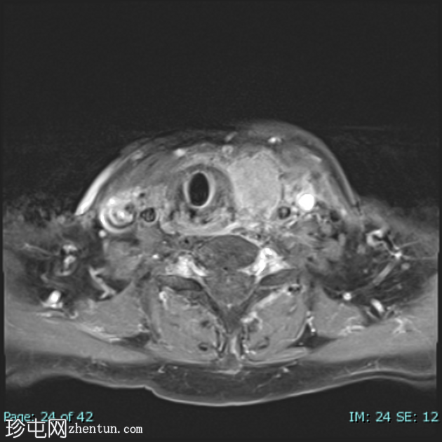 低分化甲状腺癌（FDG PET-CT）