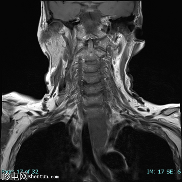 低分化甲状腺癌（FDG PET-CT）