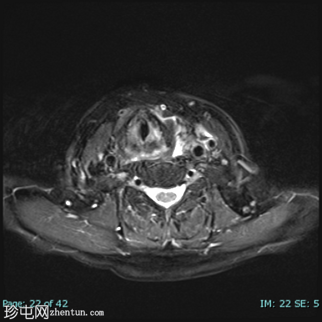 低分化甲状腺癌（FDG PET-CT）