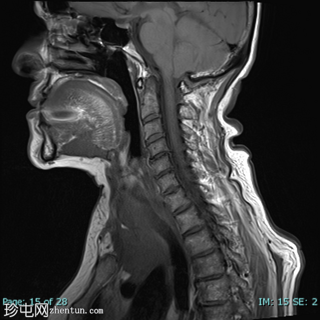 低分化甲状腺癌（FDG PET-CT）