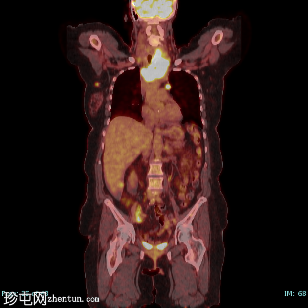 低分化甲状腺癌（FDG PET-CT）