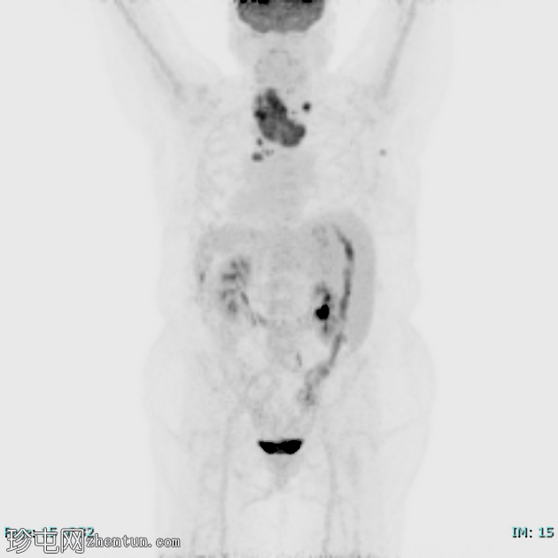 低分化甲状腺癌（FDG PET-CT）