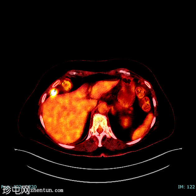 低分化甲状腺癌（FDG PET-CT）