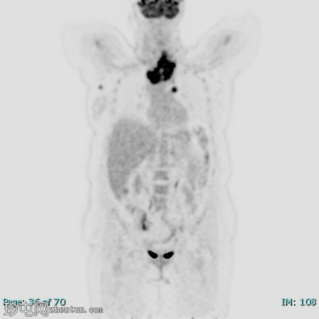 低分化甲状腺癌（FDG PET-CT）