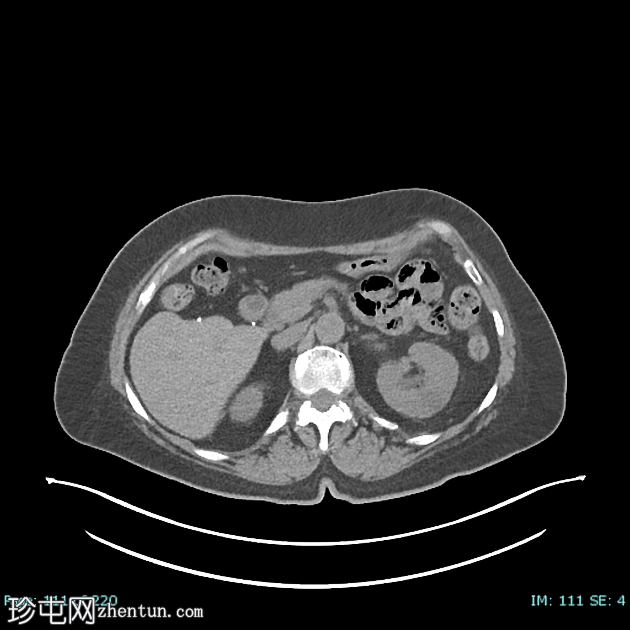 低分化甲状腺癌（FDG PET-CT）