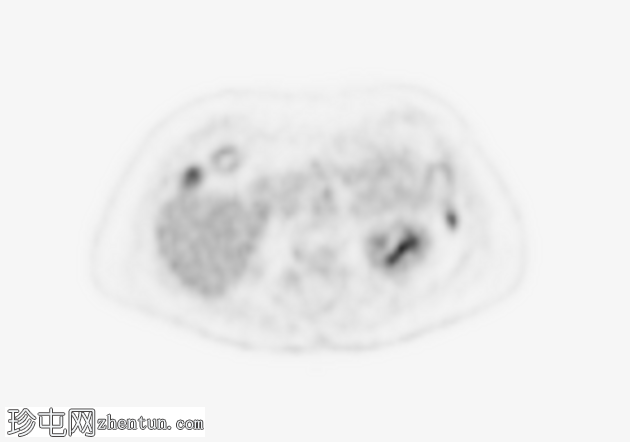 低分化甲状腺癌（FDG PET-CT）