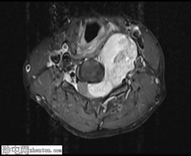 颈部神经鞘瘤