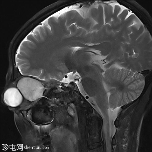 眼眶海绵状血管瘤