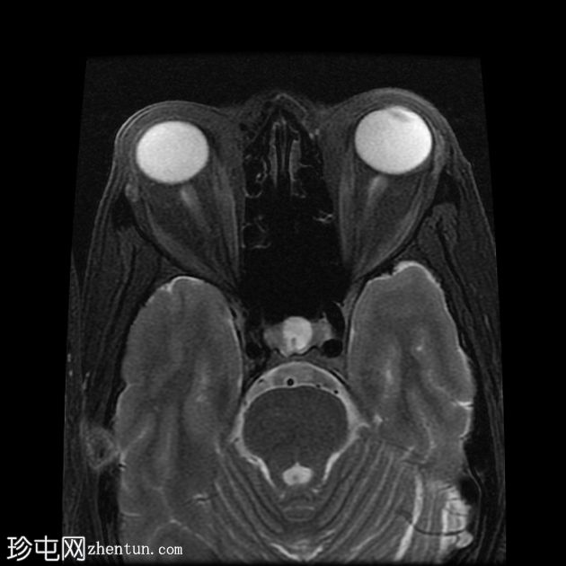 甲状腺相关眼眶病