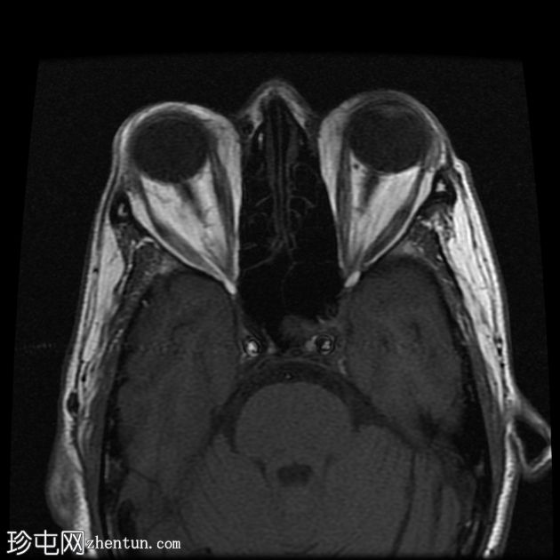 甲状腺相关眼眶病