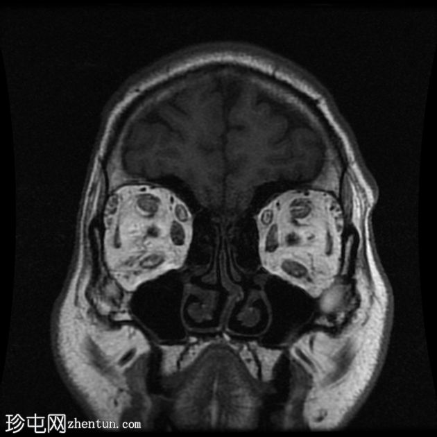 甲状腺相关眼眶病