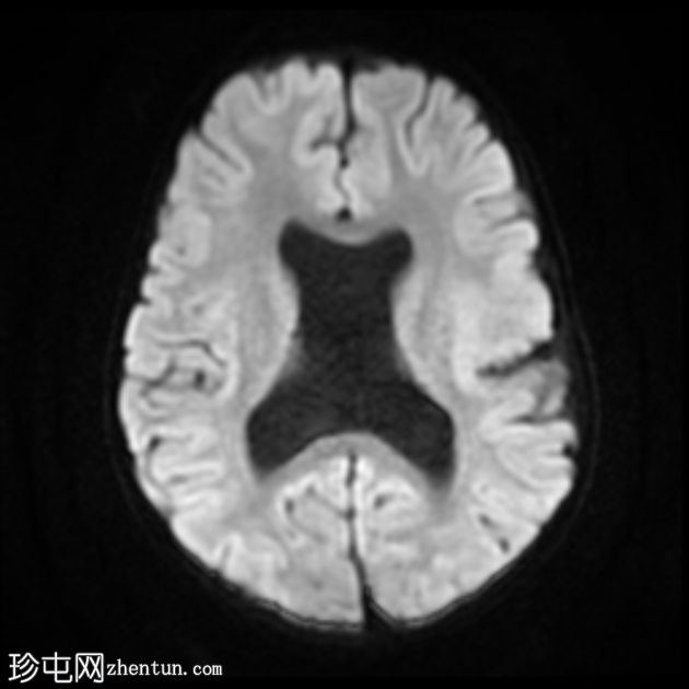 视中隔发育不良