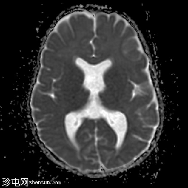 视中隔发育不良