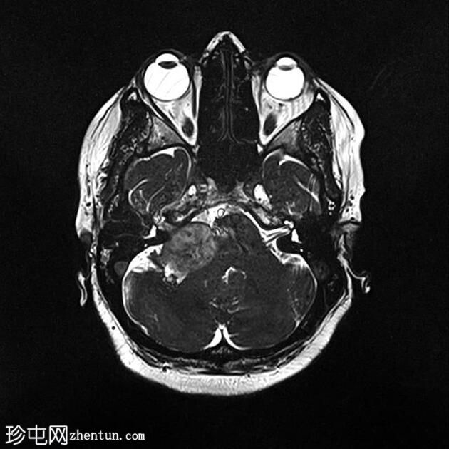 伴有管内扩散的听神经瘤