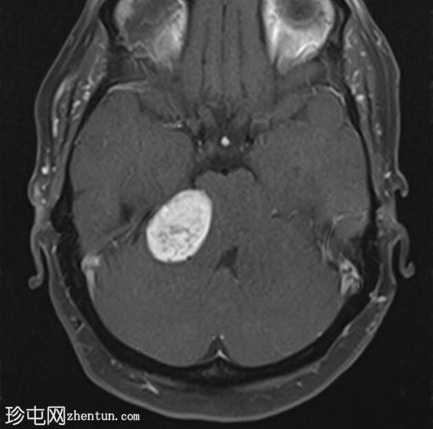 伴有管内扩散的听神经瘤