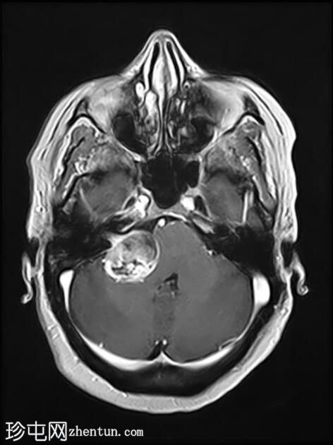 伴有管内扩散的听神经瘤