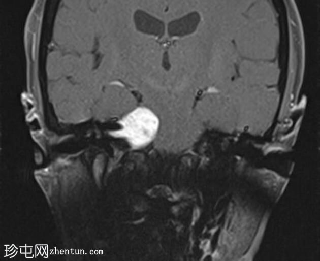 伴有管内扩散的听神经瘤