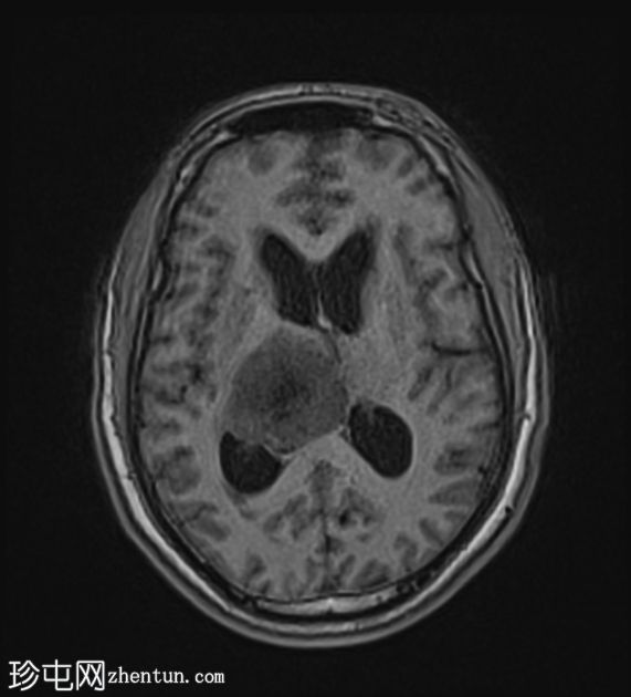 丘脑胶质瘤