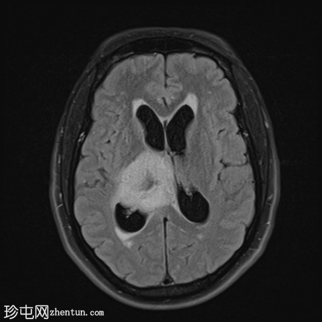 丘脑胶质瘤