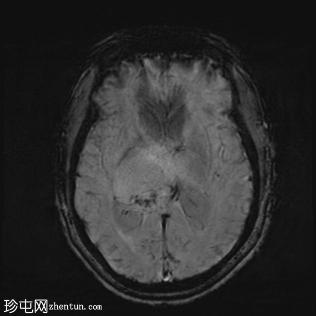 丘脑胶质瘤