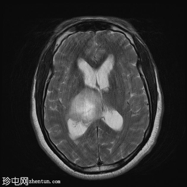 丘脑胶质瘤