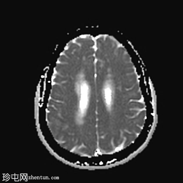 丘脑胶质瘤