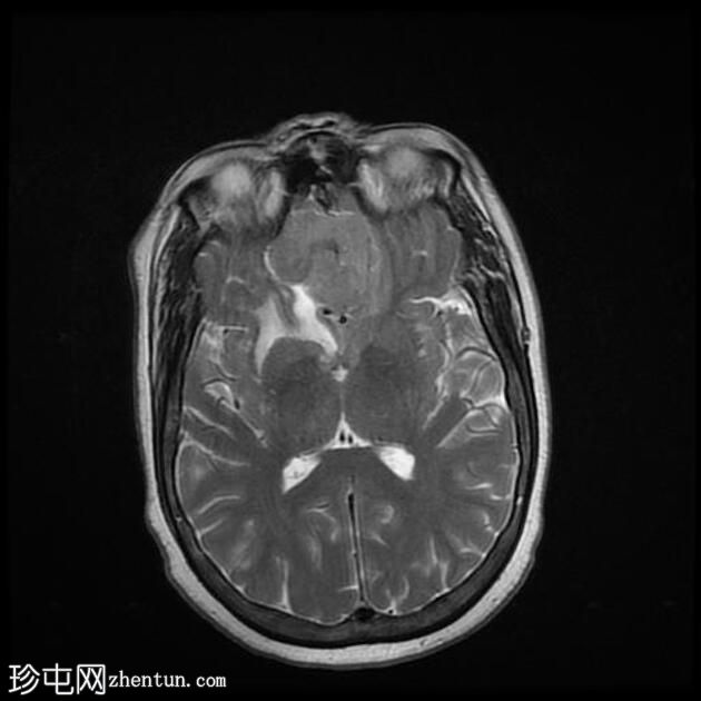 嗅沟脑膜瘤