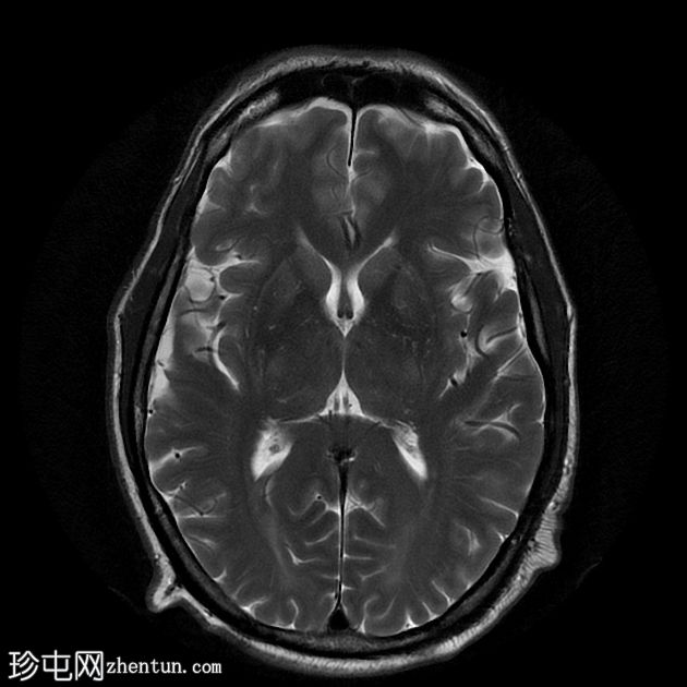 获得性肝脑变性