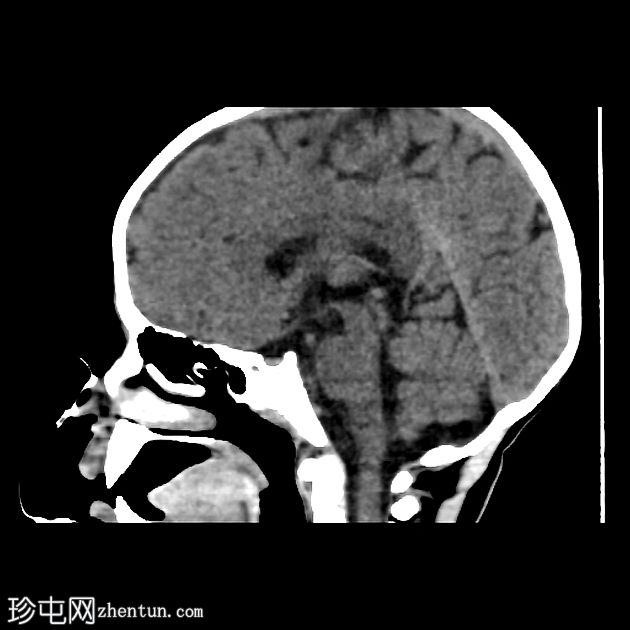 小脑幕发育不全伴有部分枕叶疝