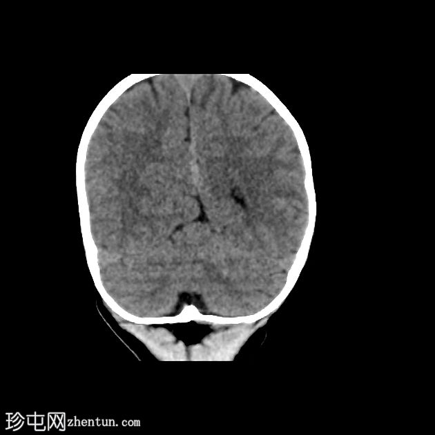 小脑幕发育不全伴有部分枕叶疝