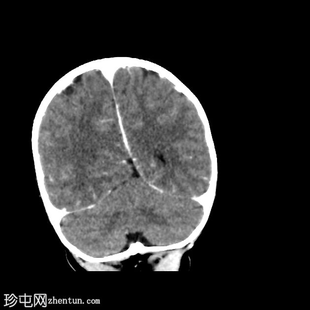 小脑幕发育不全伴有部分枕叶疝